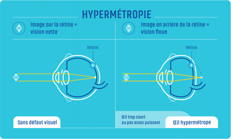 edgard-opticiens-hypermetropie